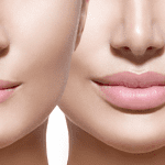 Lip augmentation