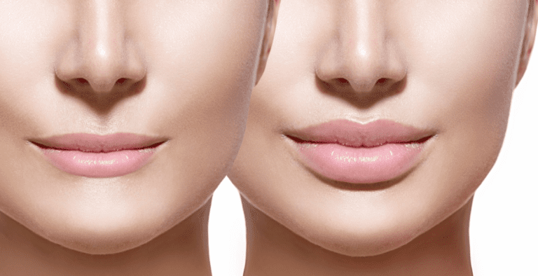 Lip augmentation